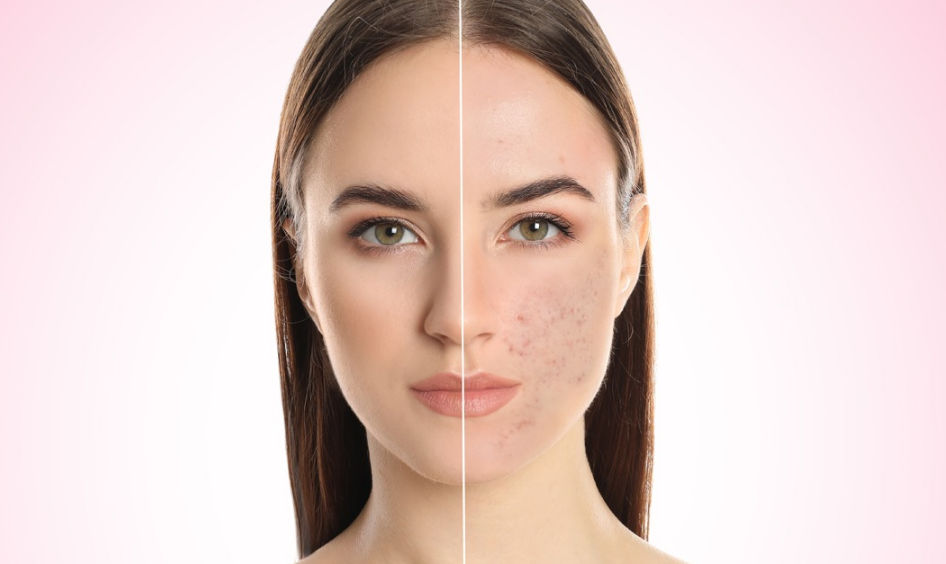 What Reasons For Open Pores? Know The Home Remedies To Reduce Open Pores!