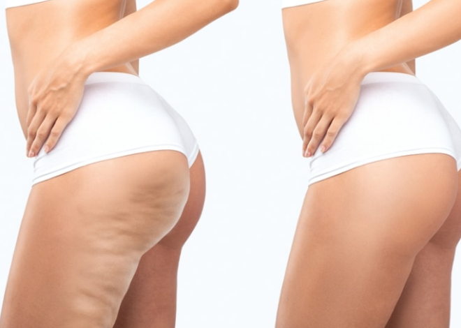 Celluless Bewertungen – Anti-Cellulite-Gel für Frauen, Preis, lohnt sich der Kauf?