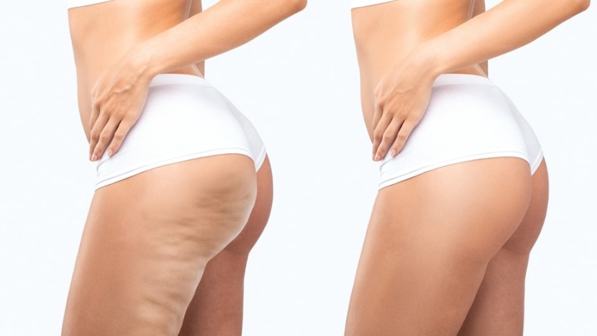 Celluless Bewertungen – Anti-Cellulite-Gel für Frauen, Preis, lohnt sich der Kauf?